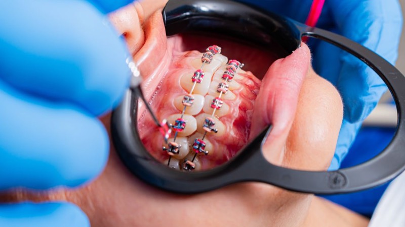 Primer plano de brackets metálicos colocados en la arcada superior
