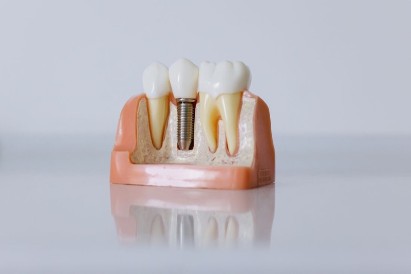 Modelo anatómico de un implante dental sobre fondo claro